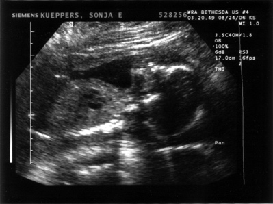 ultrasound image of 20-week-old fetus